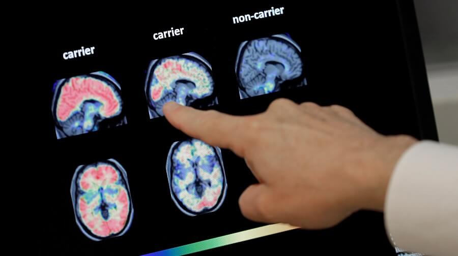 В США одобрили новый препарат против Альцгеймера